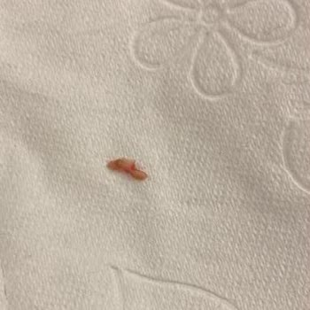 Özel Pia Dental Ağız ve Diş Sağlığı Polikliniği 20'lik Diş Çekimi, Kök Problemi