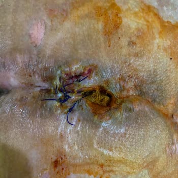 Adnan Menderes Üniversitesi Hastanesi Hastane İhmalleri Ve Doktor Hatası Yüzünden Ölüm