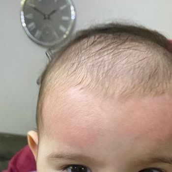 Uni Baby Islak Mendil Alerji Yaptı