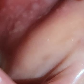 Uzdent Ağız ve Diş Sağlığı Merkezi Uzdent Diş Merkezi Tedavi Sonrası Ağzımda Yaralarım Oluştu