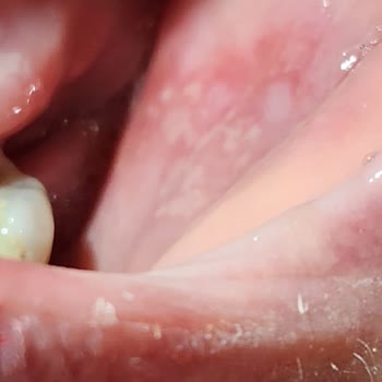 Uzdent Ağız ve Diş Sağlığı Merkezi Uzdent Diş Merkezi Tedavi Sonrası Ağzımda Yaralarım Oluştu