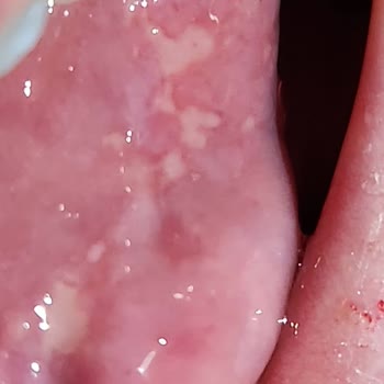 Uzdent Ağız ve Diş Sağlığı Merkezi Uzdent Diş Merkezi Tedavi Sonrası Ağzımda Yaralarım Oluştu