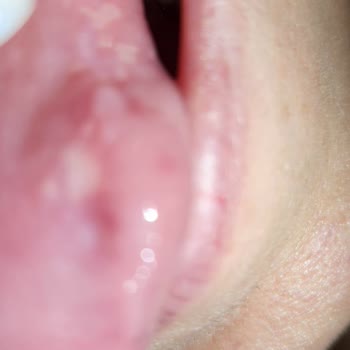 Uzdent Ağız ve Diş Sağlığı Merkezi Uzdent Diş Merkezi Tedavi Sonrası Ağzımda Yaralarım Oluştu