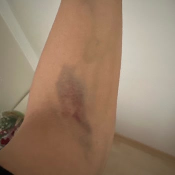Acıbadem Hastanesi Kan Tahlili Sırasında Yaşanan Sıkıntı