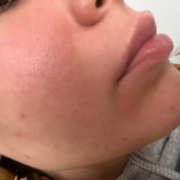 Iva Natura İva Natura Markası Yüzümü Yaktı