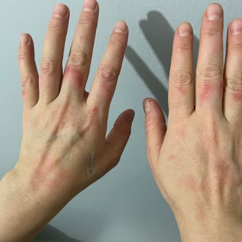 Moda Lucci Epilatör Tahriş