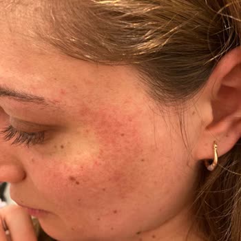 Gratis Bee Beauty Mor Saç Kremi Alerjik Reaksiyon