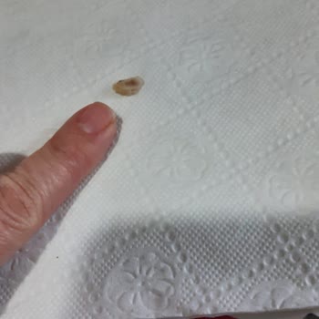 Lezita Piliç Kroket İçinden Kemik Parçası Çıkması