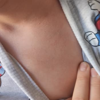 Argivit Smart Oğlumun Gözlerini Şişirdi Kaşıntı Kabarcıklar Ve Ateş Ol