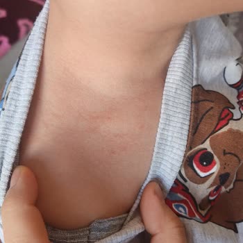 Argivit Smart Oğlumun Gözlerini Şişirdi Kaşıntı Kabarcıklar Ve Ateş Ol