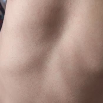 Argivit Smart Oğlumun Gözlerini Şişirdi Kaşıntı Kabarcıklar Ve Ateş Ol