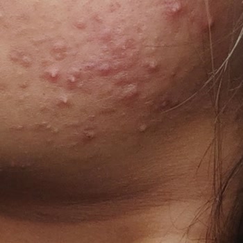 MHRS (Merkezi Hekim Randevu Sistemi) Cildiye Doktoru Yok