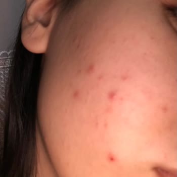 Cerave Köpüren Temizleyici Yüzümde Sivilce Yaptı