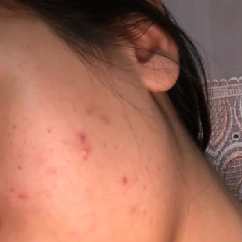 Cerave Köpüren Temizleyici Yüzümde Sivilce Yaptı