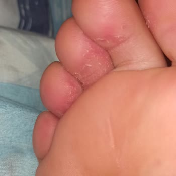 FLO Ayakkabı Aşırı Kalitesiz Pişik Yapan Ayakkabı