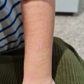 Özel Medar Hastaneleri Sakarya'da Oğlumun Alcı Çıkarılırken Kolunda Spiralle Kesildi!