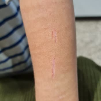 Özel Medar Hastaneleri Sakarya'da Oğlumun Alcı Çıkarılırken Kolunda Spiralle Kesildi!