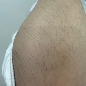 Nets Polikliniği Lazer Epilasyon Memnuniyetsizliği
