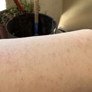 Nets Polikliniği Lazer Epilasyon Memnuniyetsizliği