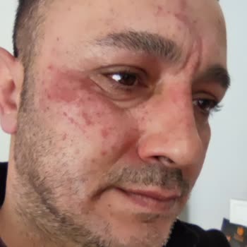 Kiva Kozmetik Ürünleri Yüzümü Yaktı