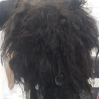 Special Emir Ercan  Protez Saç Merkezi Mağduriyeti!