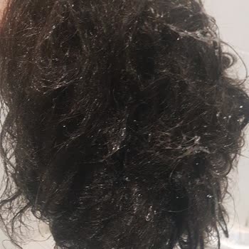 Special Emir Ercan  Protez Saç Merkezi Mağduriyeti!