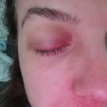 Garnier Makyaj Temizleme Solüsyonu Yüzünden Gözüm Enfeksiyon Kaptı