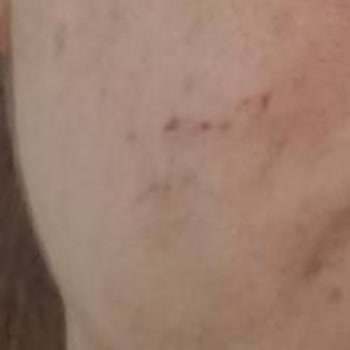 American Clinic (Bakırköy) 12 Hifu İşlemi