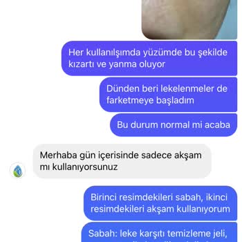 Rahik-i Mahtum Rahiki M Ürünleri Cildime Zarar Verdi-müşteri Temsilcisi Mağduriyeti