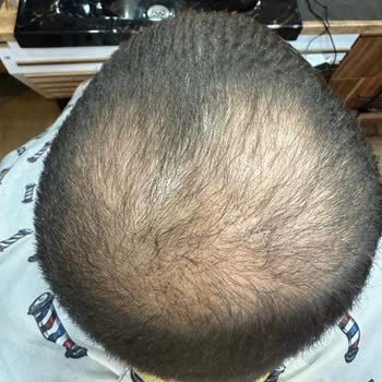 Bursa Esteticare Saç Ekimi Başarısızlığı