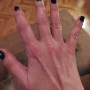 Maruderm Hyaluranic Acid Moisturizing Cream Yanma Kızarma Yaptı