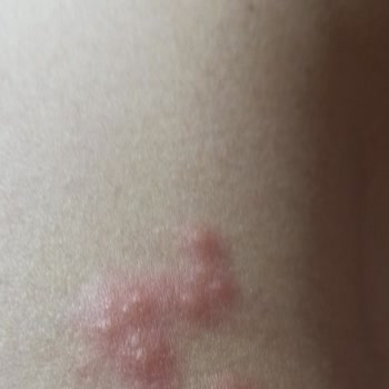 İbucold C Alerji Yaptı