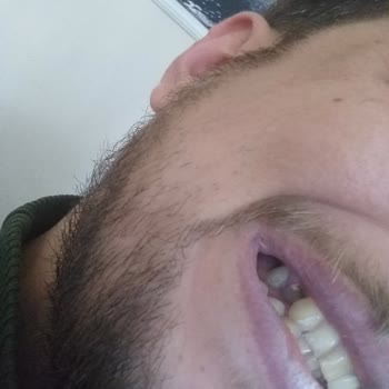 AFK Diş Kliniği Dolgu Sonrası Yaşanan Sorunlar Ve Ücret Tepkisi