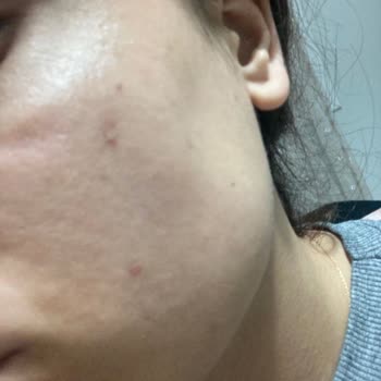 Bioderma Sahte Ürün Cildimi Mahvetti