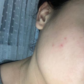 Bioderma Sahte Ürün Cildimi Mahvetti