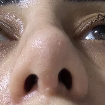 Doç. Dr. Tahsin Oğuz Acartürk Başarısız Burun Estetiği Operasyonu Ve Sonuçları