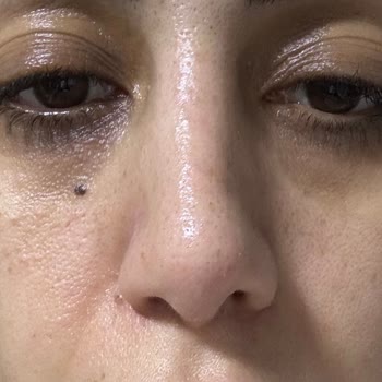 Doç. Dr. Tahsin Oğuz Acartürk Başarısız Burun Estetiği Operasyonu Ve Sonuçları