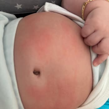 Mustela Şampuan Ve Yağ Alerji Yaptı
