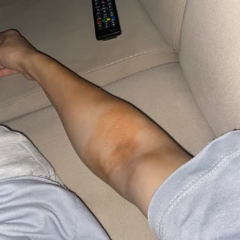 Amasya Üniversitesi Sabuncuoğlu Şerefeddin Eğitim ve Araştırma Hastanesi Yanlış Tedavi Sonucu Süren Ağrılarım