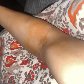 Amasya Üniversitesi Sabuncuoğlu Şerefeddin Eğitim ve Araştırma Hastanesi Yanlış Tedavi Sonucu Süren Ağrılarım