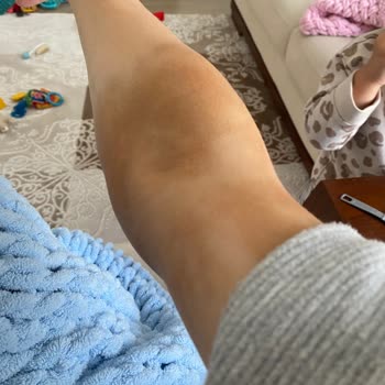 Amasya Üniversitesi Sabuncuoğlu Şerefeddin Eğitim ve Araştırma Hastanesi Yanlış Tedavi Sonucu Süren Ağrılarım