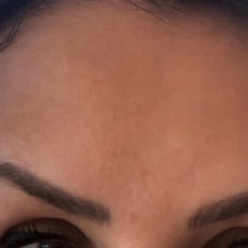 Suit Güzellik Merkezleri Suit Lara Güzellik Merkezi Hatalı Botoks Uygulaması