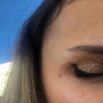 Suit Güzellik Merkezleri Suit Lara Güzellik Merkezi Hatalı Botoks Uygulaması