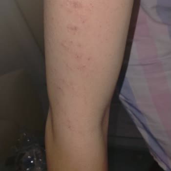 Aris Çukurambar Vip Lazer Epilasyon Hayal Kırıklığı