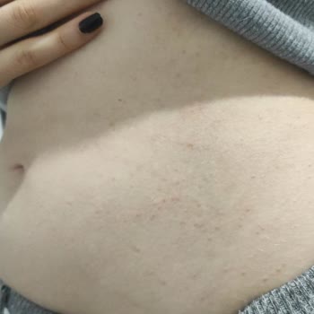 Mustela Çatlak Kremi Alerji Yaptı