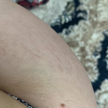 Aymira Koçaklı Yaşam Merkezi Damarımın İşlemi Bilmeyen Kişi Tarafından Zedelenmesi