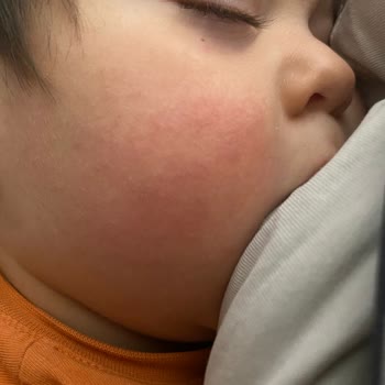 Mustela Bebeğimin Yanaklarını Egzama Yaptı