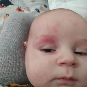Mustela'nın Ürünleri Oğlumda Kabartı Ve Kızarıklık Yaptı!