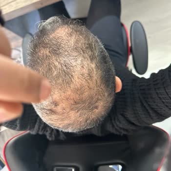 Aris Güzellik Merkezleri Antalya Vip Saç Dermatemi Hüsranı