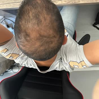 Aris Güzellik Merkezleri Antalya Vip Saç Dermatemi Hüsranı